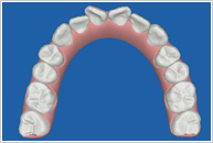 Step04 歯型をコンピューター上で3DCG化治療終了までのシミュレーションを作成